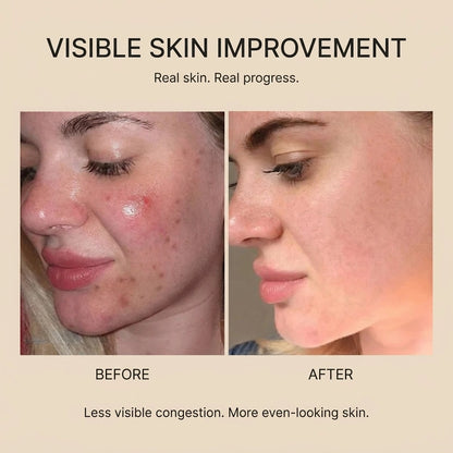 Nivara™ Succinic Acid Peeling Pad